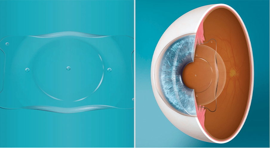 Illustration de la lentille intraoculaire EVO ICL pour chirurgie réfractive chez PremiumVision à Casablanca