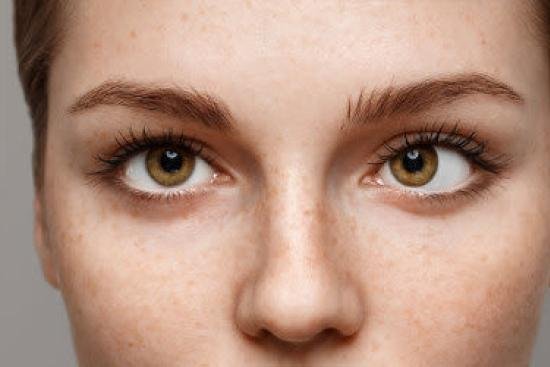 Gros plan sur le visage d'une femme présentant un strabisme convergent avec déviation de l'œil avant traitement chez PremiumVision à Casablanca